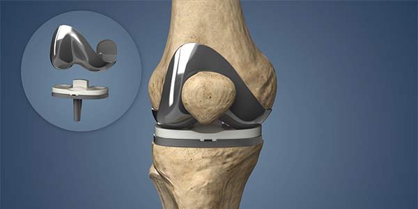 Joint Replacement in Nagpur